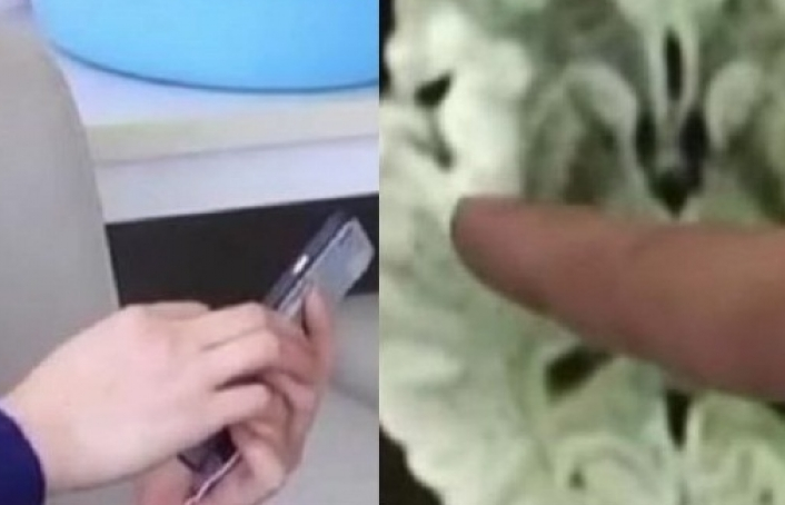 Trung Quốc: Bị cục máu đông trong não nghi do dán mắt vào điện thoại