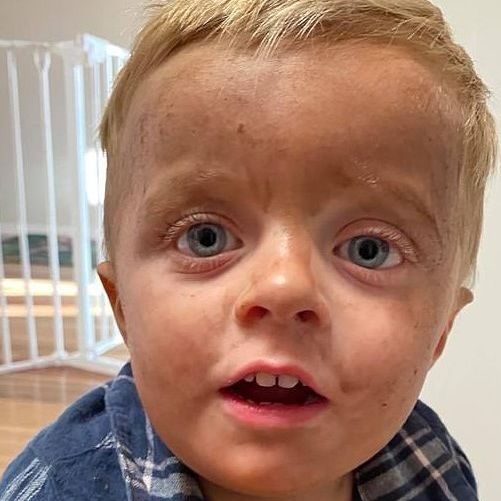 Cậu bé mang làn da nhem nhuốc vì nhầm thuốc nhuộm da với xà phòng