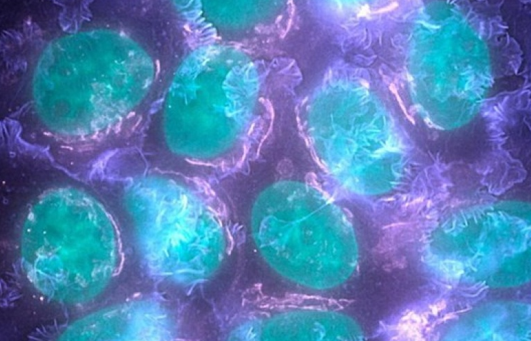 Xác định được các gene đột biến có khả năng gây bệnh ung thư vú