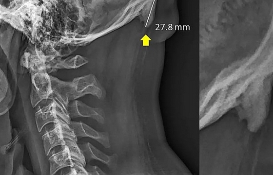 Sốc: Sử dụng smartphone quá nhiều, bạn có thể bị 'mọc đuôi' sau gáy