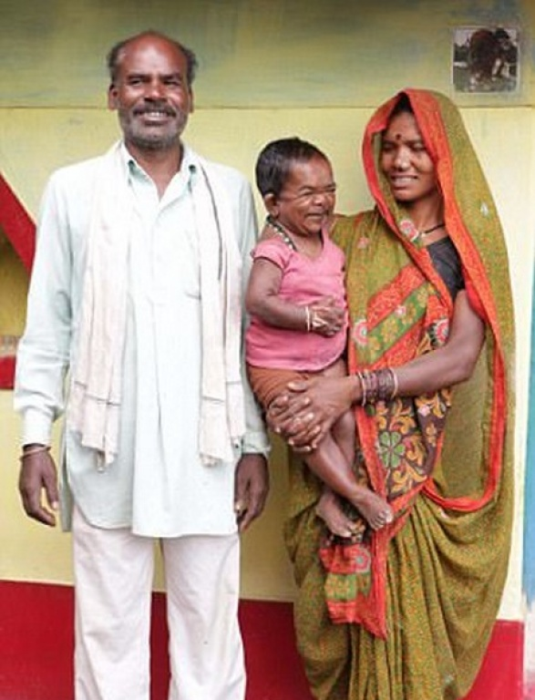 Người đàn ông 50 tuổi trong hình hài đứa trẻ cao 73cm