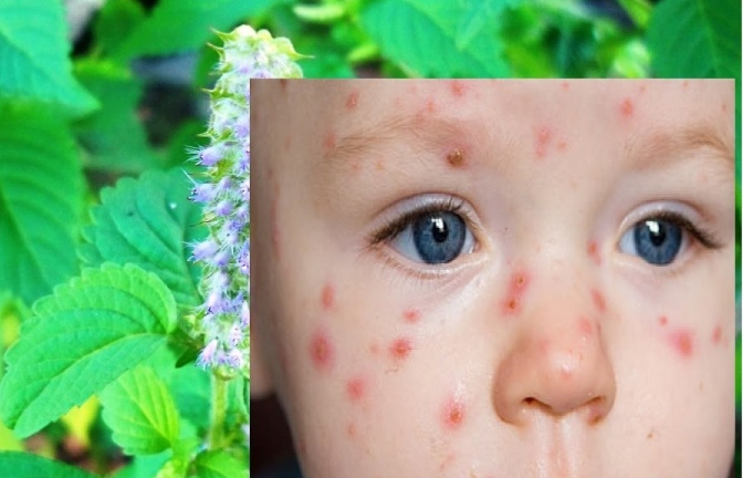 Khi trẻ bị thủy đậu cần kiêng những gì?