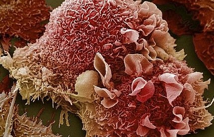 Mỹ: Phát triển phương pháp điều trị ung thư hoàn toàn mới