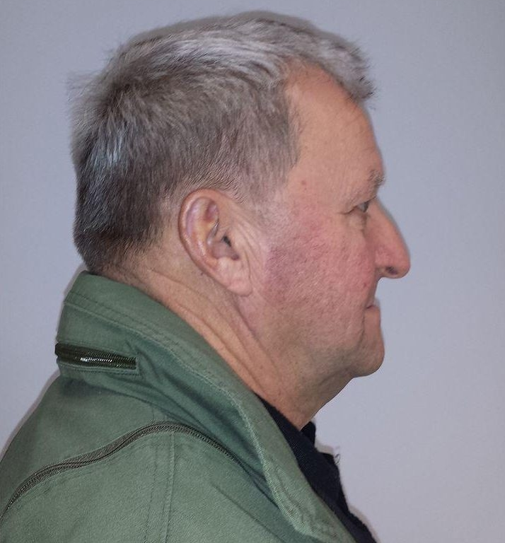 Người đàn ông bạc trắng cả đầu chỉ sau một đêm