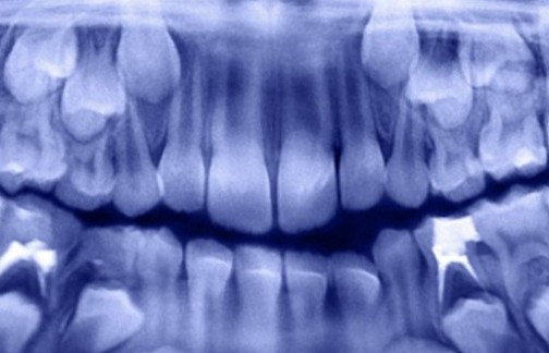 Ấn Độ: Các nha sĩ lấy ra hơn 500 chiếc răng từ miệng của một cậu bé… 7 tuổi