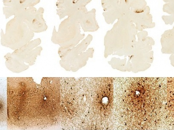 Phát hiện loại protein hỗ trợ chẩn đoán bệnh gây hại não mãn tính