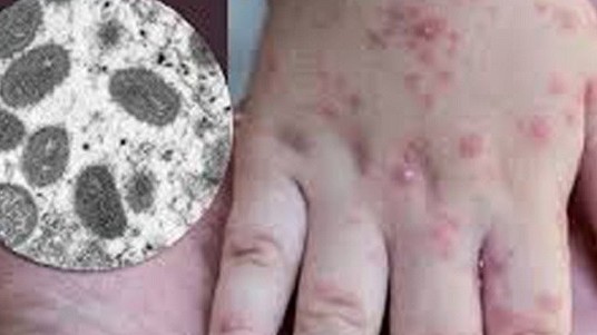 Bộ Y tế ra chỉ đạo khẩn khi TP. Hồ Chí Minh ghi nhận ca đậu mùa khỉ đầu tiên