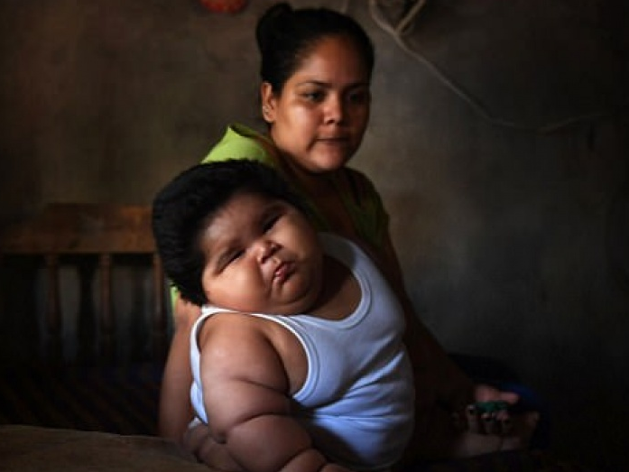 Cậu bé 10 tháng tuổi nặng gần 30kg