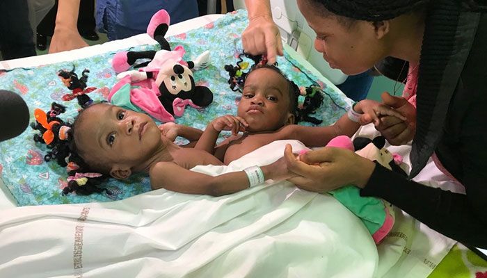 Tách rời thành công cặp bé song sinh dính liền người Cameroon tach roi thanh cong cap be song sinh dinh lien nguoi cameroon