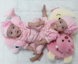 Niềm vui vỡ òa khi phẫu thuật tách thành công cặp song sinh dính liền ở Việt Nam