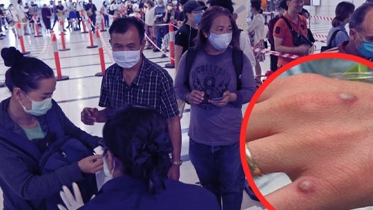 Thái Lan họp khẩn để đối phó với bệnh đậu mùa khỉ