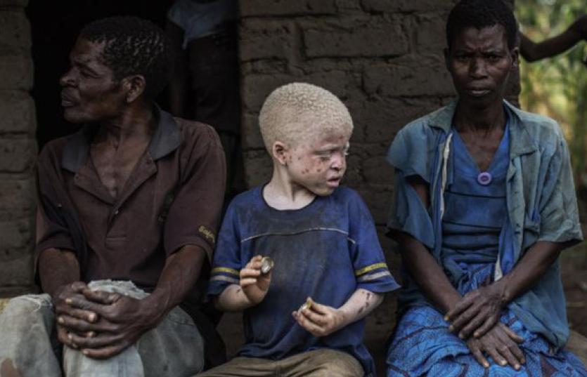 Những người bạch tạng bị săn đuổi lấy xác ở châu Phi