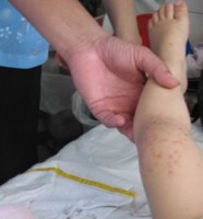 hon 300 truong hop mac benh soi tai my ke tu dau nam 2019