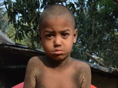 Cậu bé mắc bệnh lạ khiến cơ thể "hoá đá"