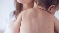 Ca mắc mới tăng gần gấp đôi, thế giới đối mặt nguy cơ bùng phát dịch sởi