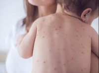 Ca mắc mới tăng gần gấp đôi, thế giới đối mặt nguy cơ bùng phát dịch sởi