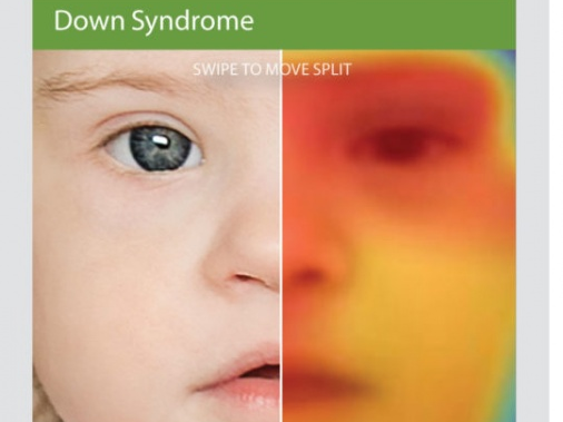 Nhận diện bệnh hiếm bằng ứng dụng của Facebook