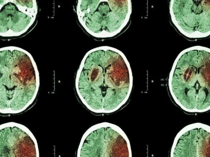 Nguy cơ đột quỵ do... quy ước giờ mùa Hè