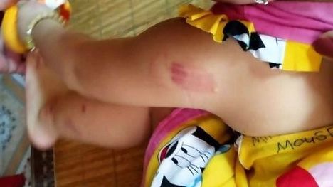 Bé gái bầm tím người khi đi học là do bị bạn cắn?